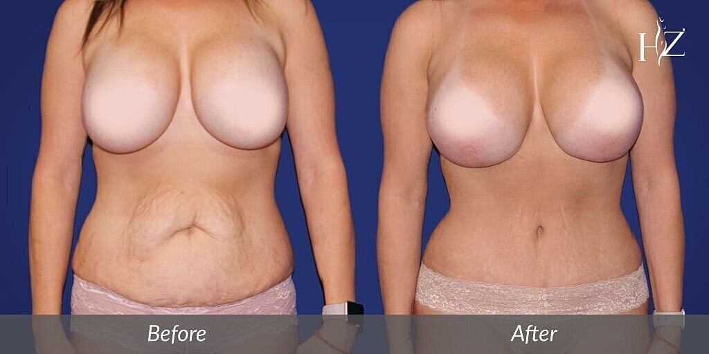 mommy makeover patient before and after 1