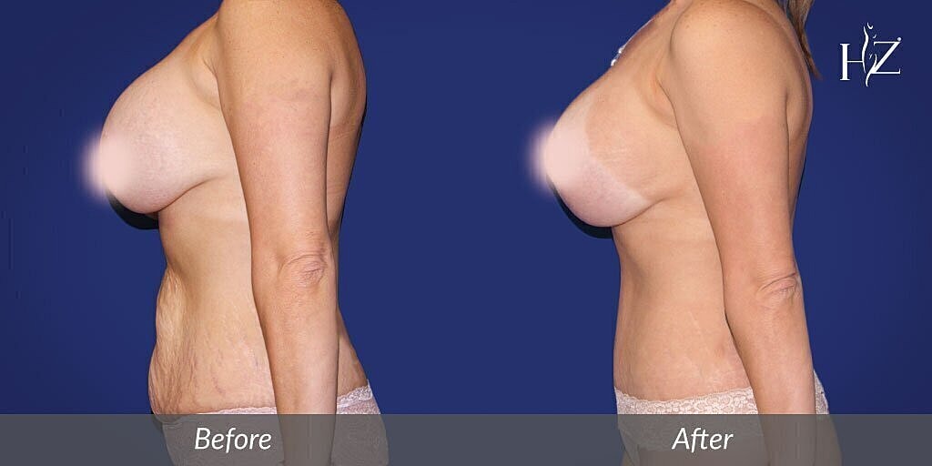 mommy makeover patient before and after 2