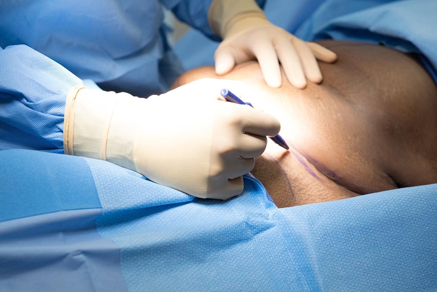 orlando plastic surgeon marking incision sites