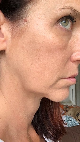 neck lift before and after neck lift recovery day by day