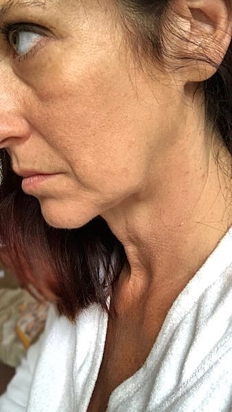 neck lift before and after neck lift recovery day by day