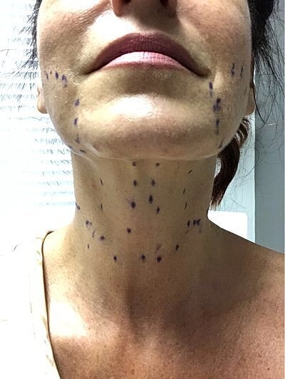 neck lift before and after neck lift recovery day by day