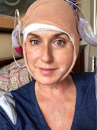 neck lift before and after, neck lift recovery day by day