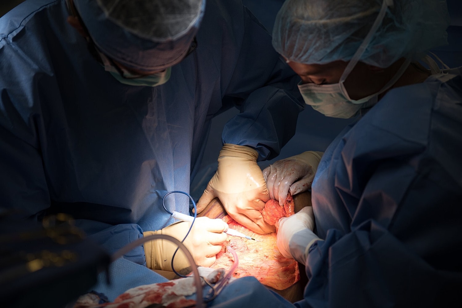 orlando plastic surgeon performing tummy tuck 2