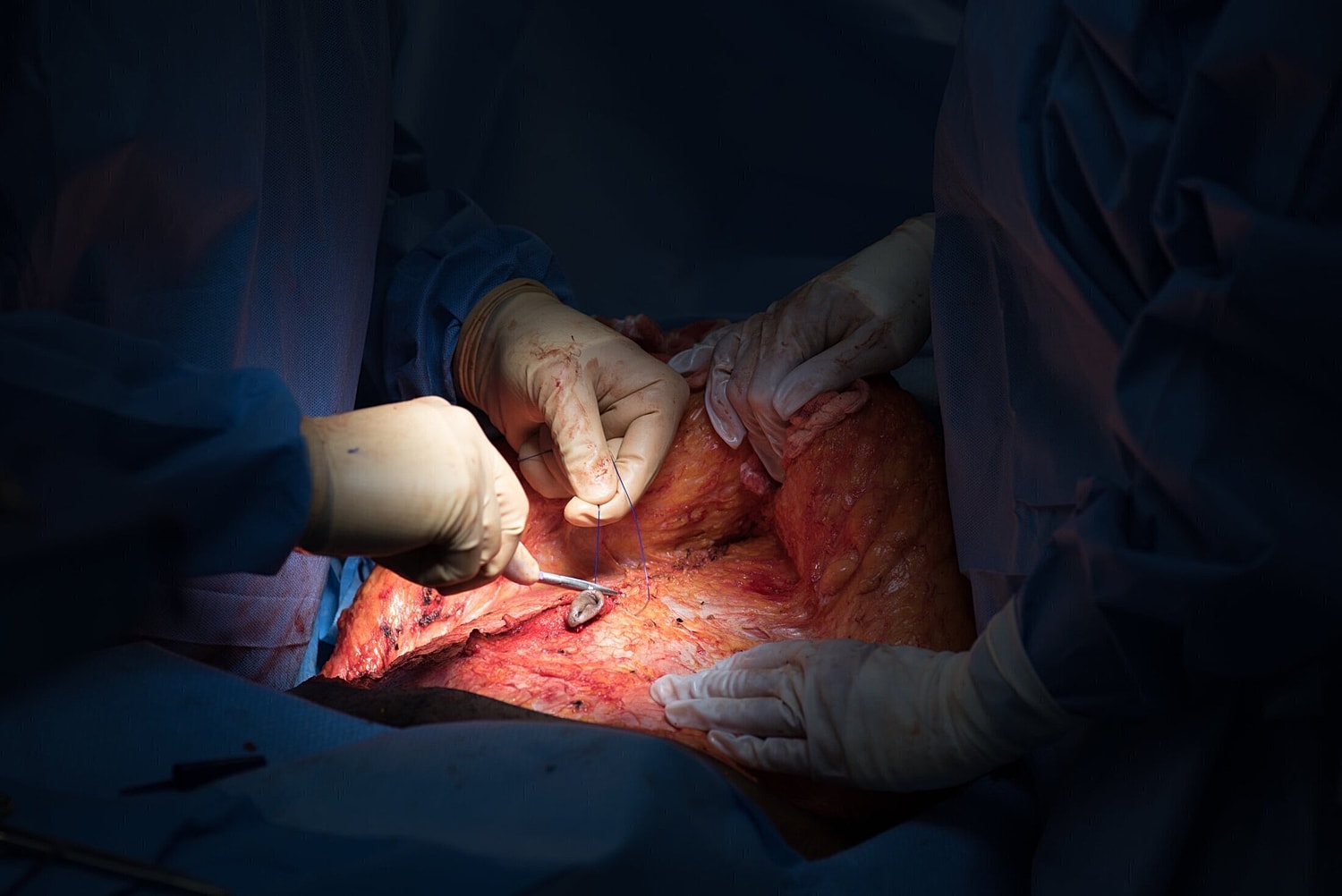 orlando plastic surgeon suturing the patient