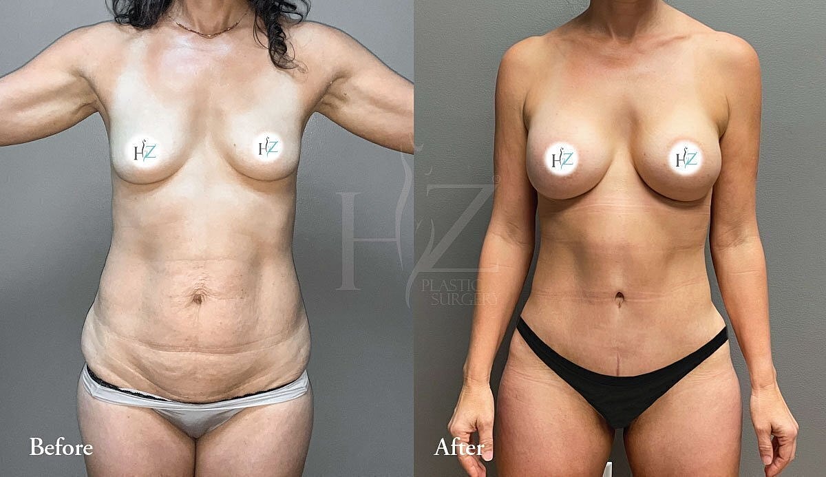 mommy makeover patient before and after 2