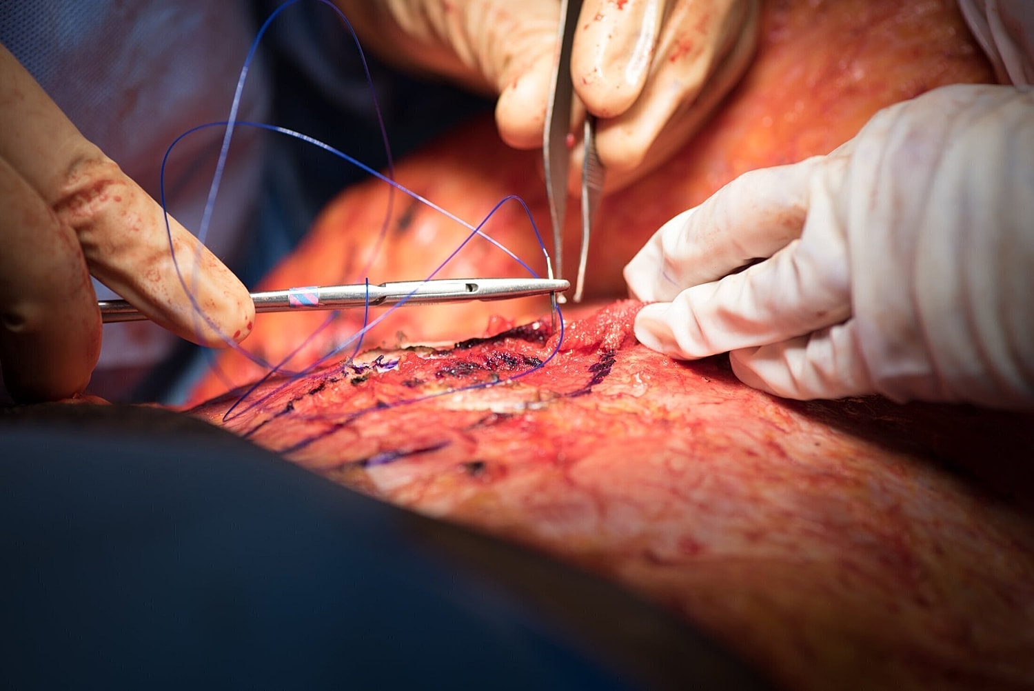 orlando plastic surgeon finishing sutures on the patient