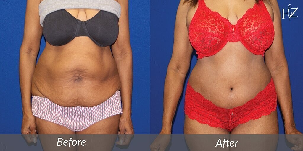 tummy tuck before after 1