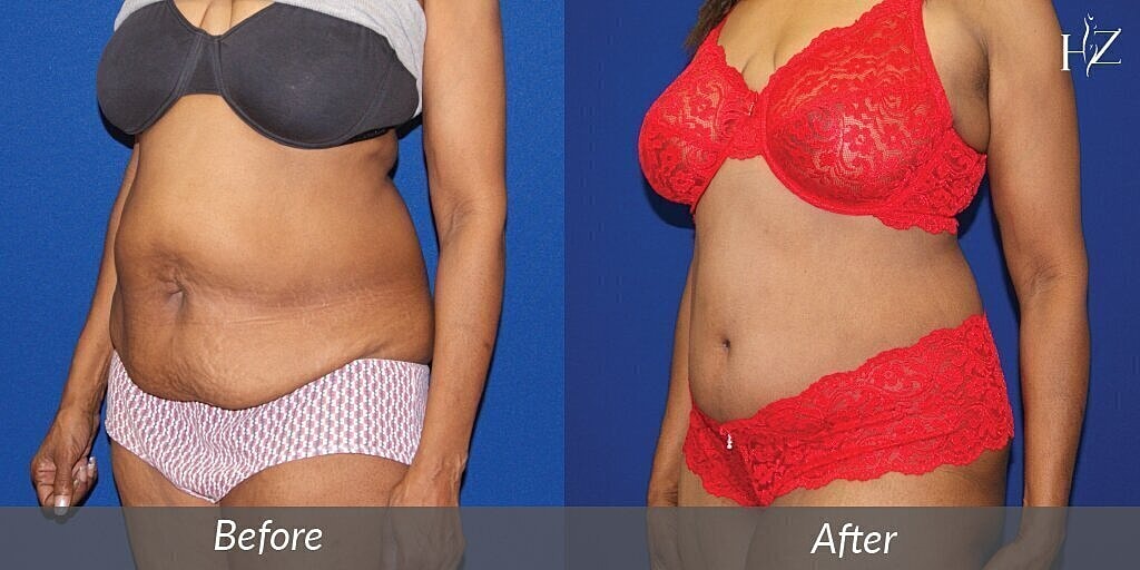 tummy tuck before after 2