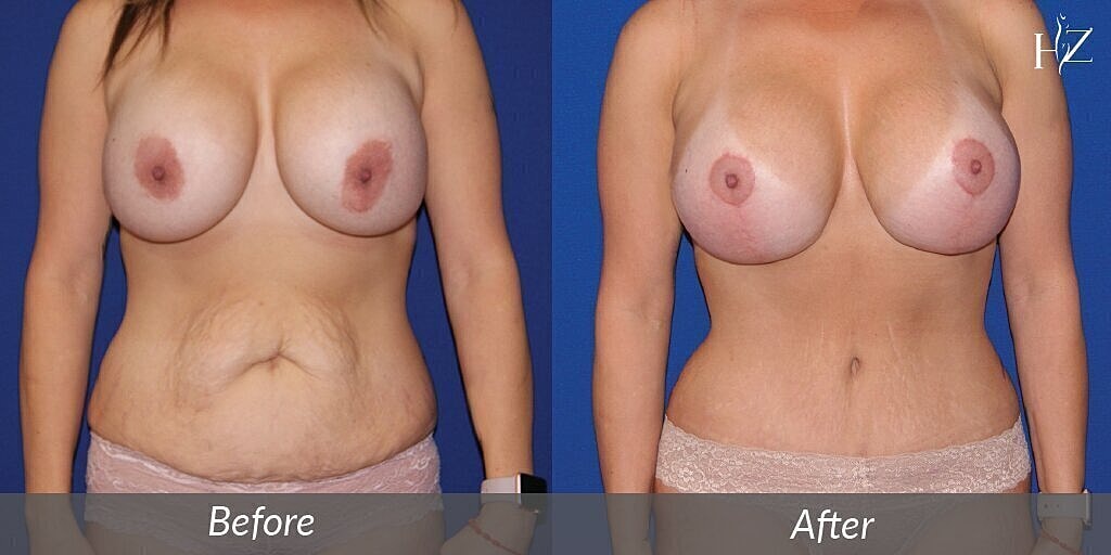 breast lift before after 1