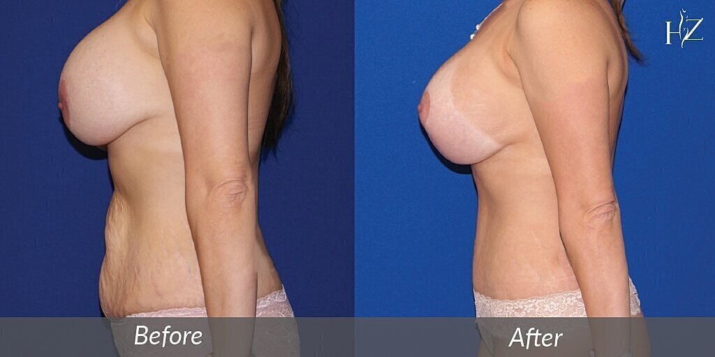 breast lift before after 2