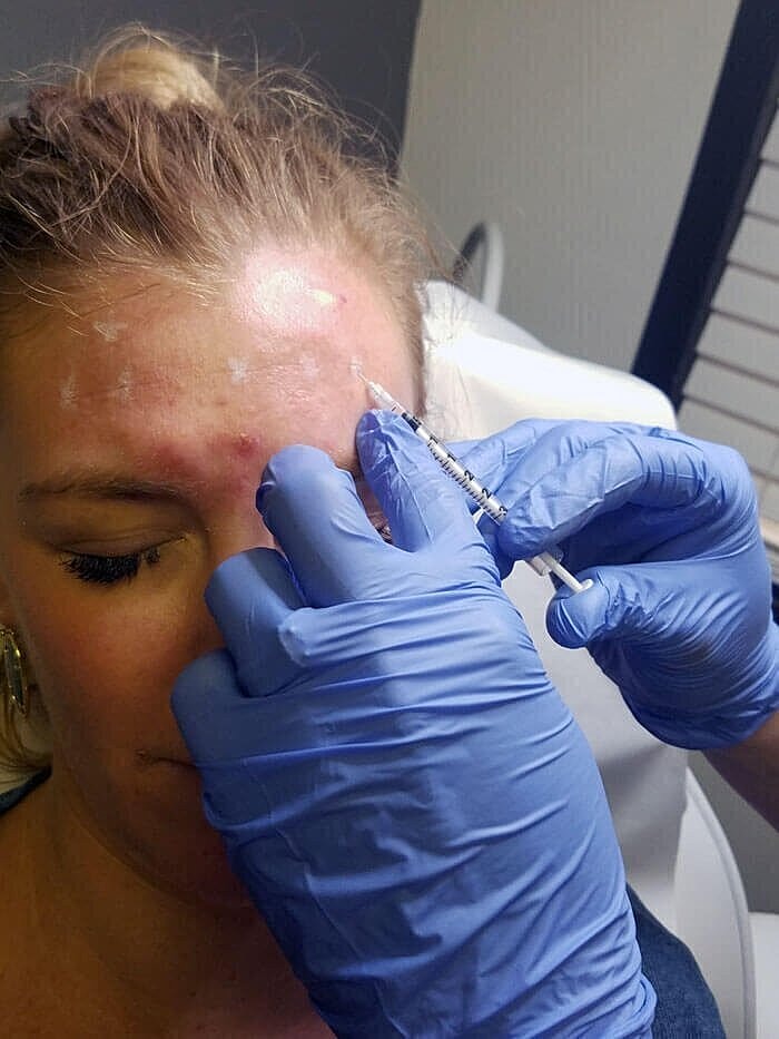 Injection treatment on woman's forehead.