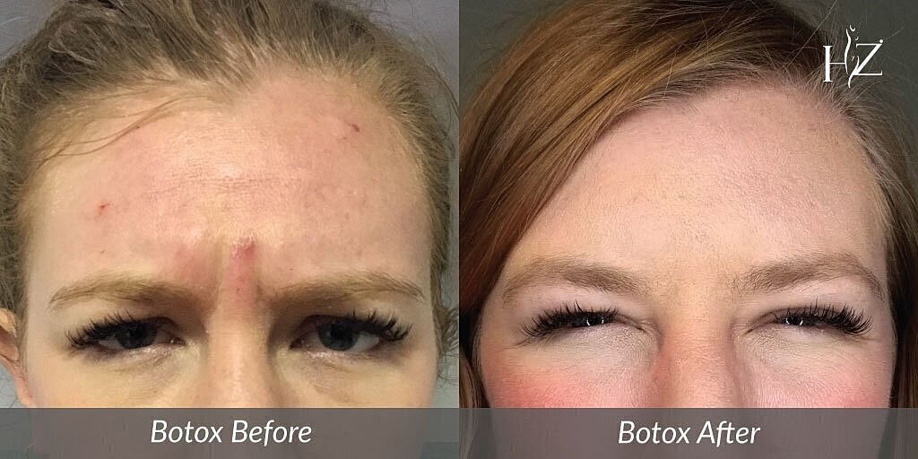 Botox treatment before and after comparison.