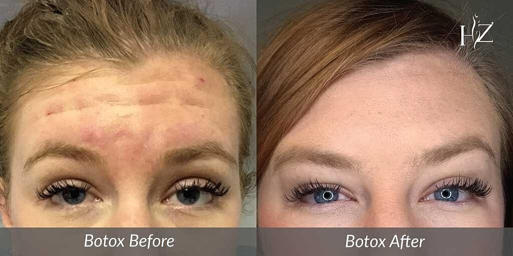 Botox treatment before and after comparison