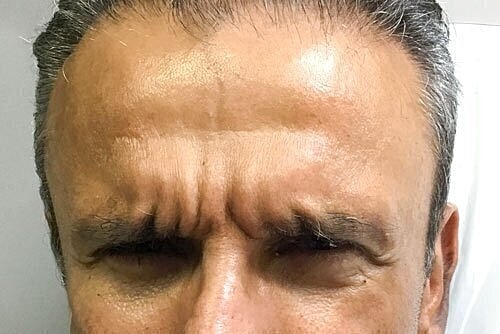 Man frowning with prominent forehead wrinkles.