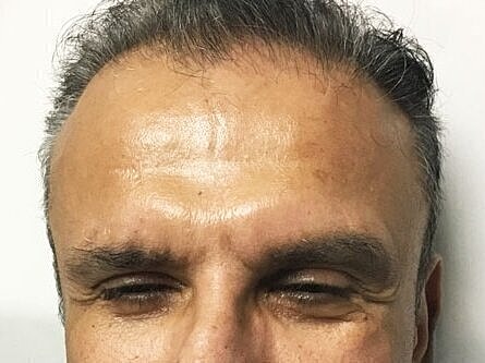 Close-up of a man's forehead and eyes.