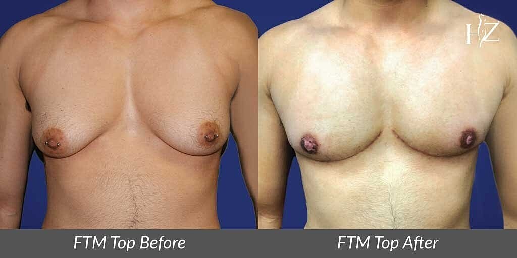 FTM chest transformation before and after images