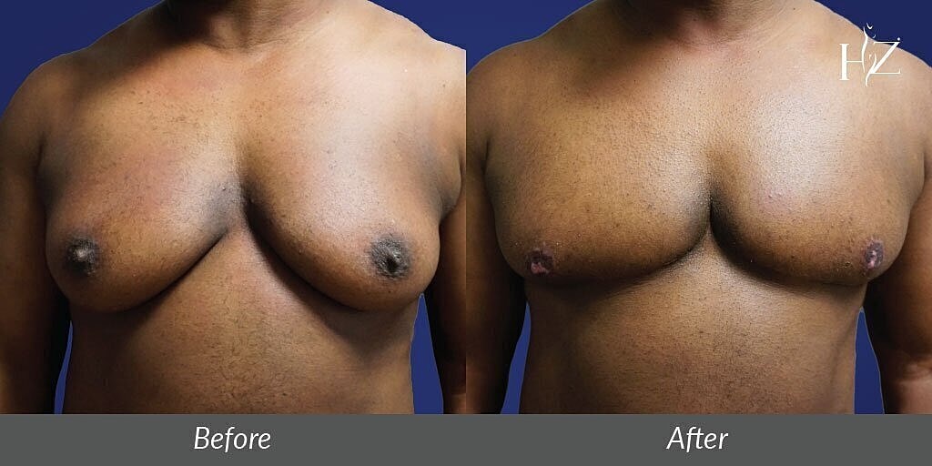 Before and after breast surgery comparison image.