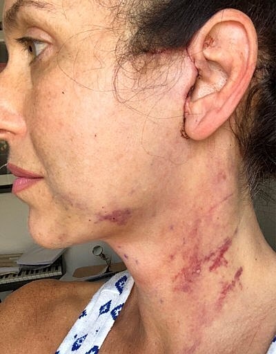 Injury marks on a woman's neck and jaw.