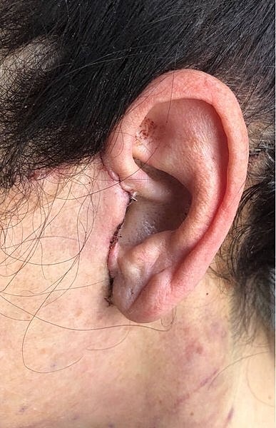 Ear with surgical stitches and healing area.