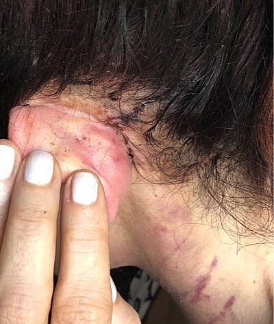 Injury near ear with visible scarring.