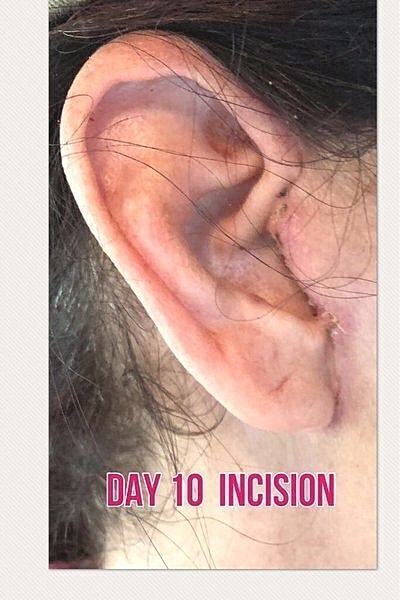 Day 10 post-surgery ear incision healing.