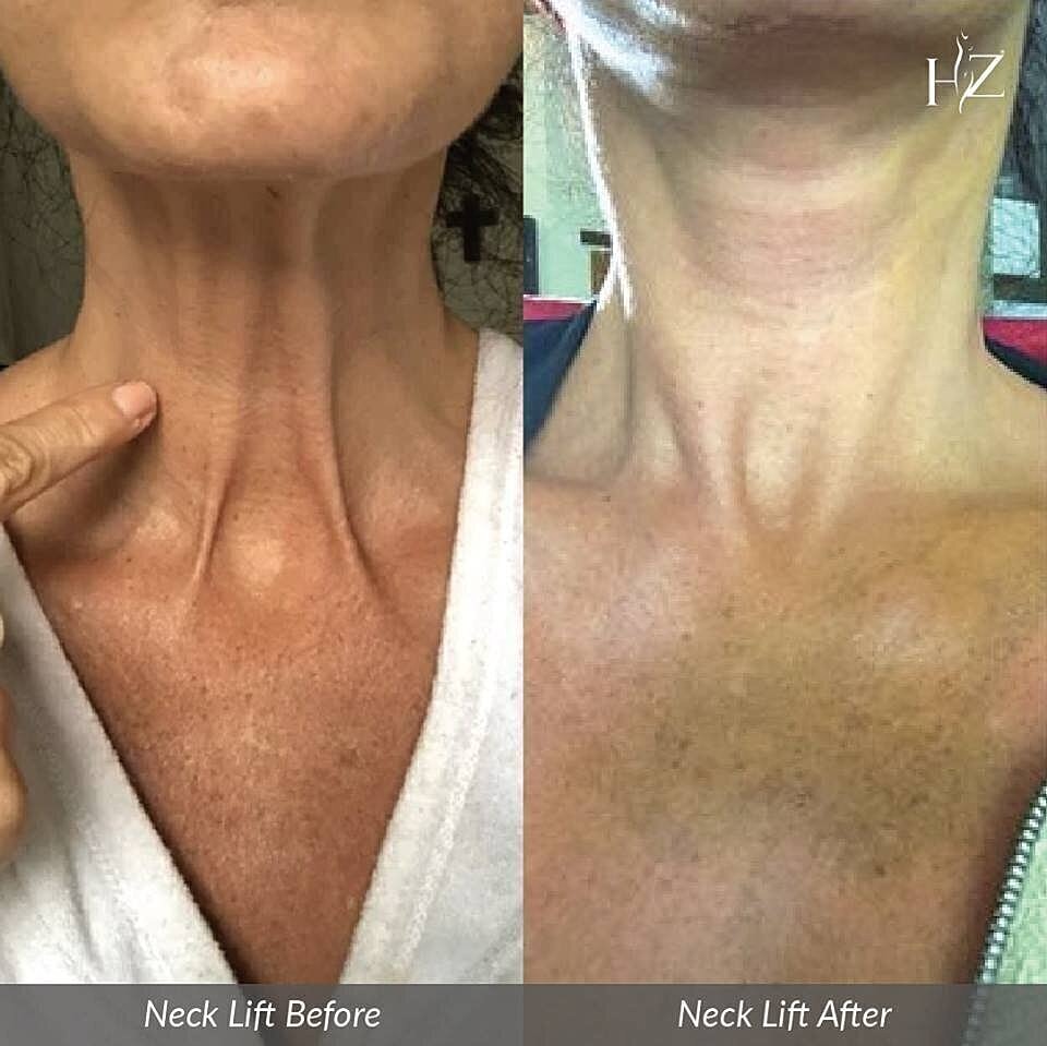 Before and after neck lift comparison image.