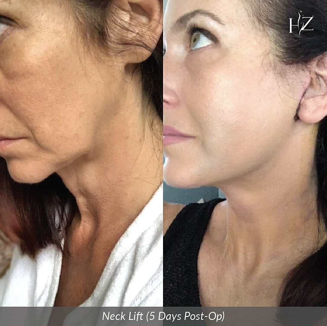 Neck lift results five days post-operation.