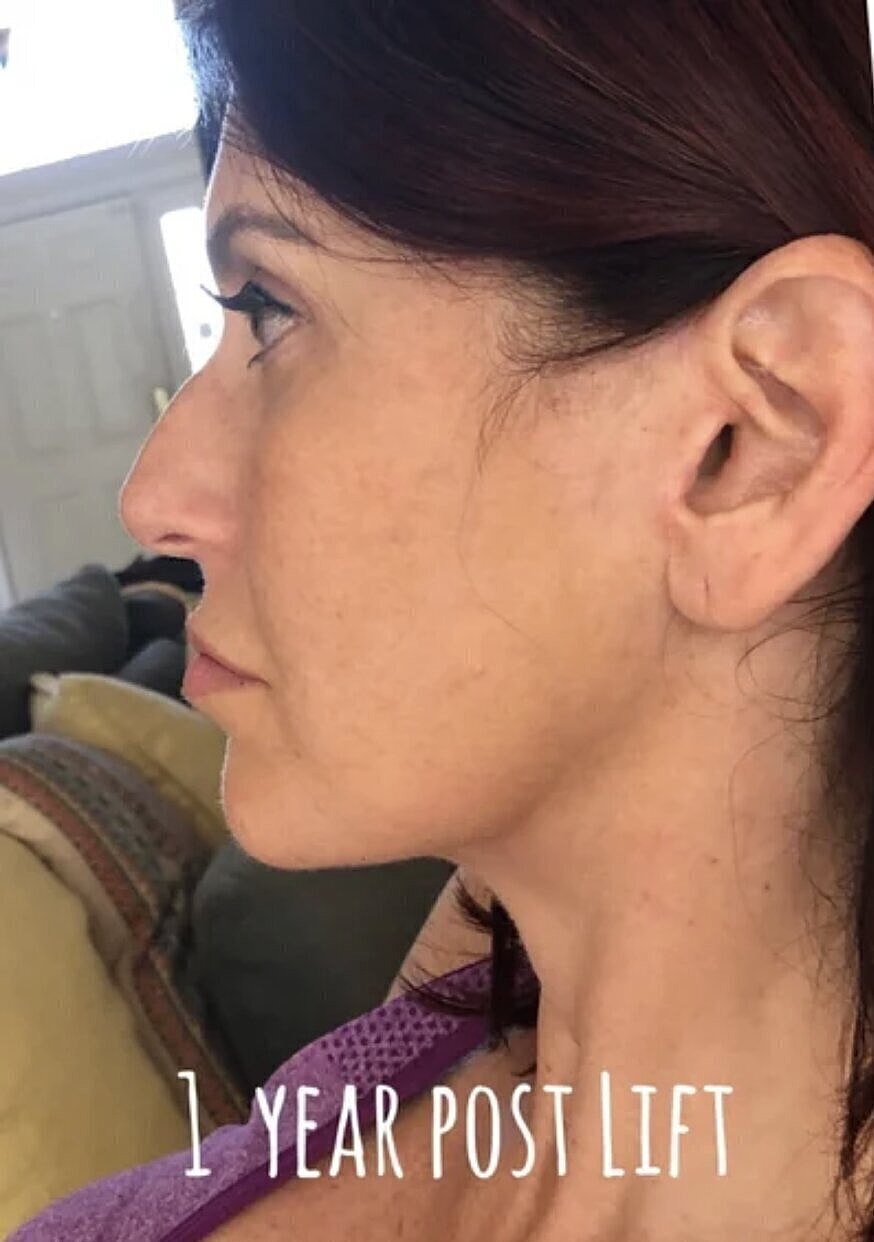Profile view after one year post lift.