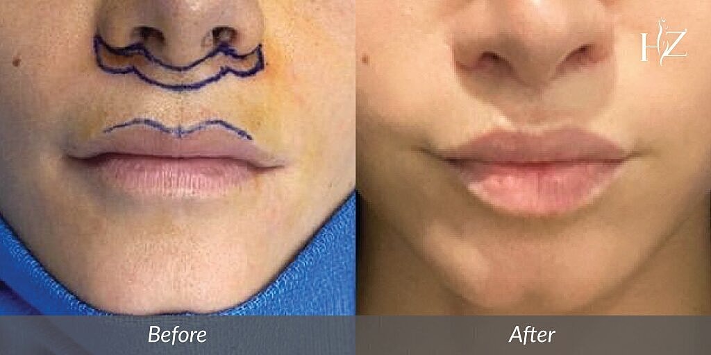 Lip enhancement procedure before and after results.