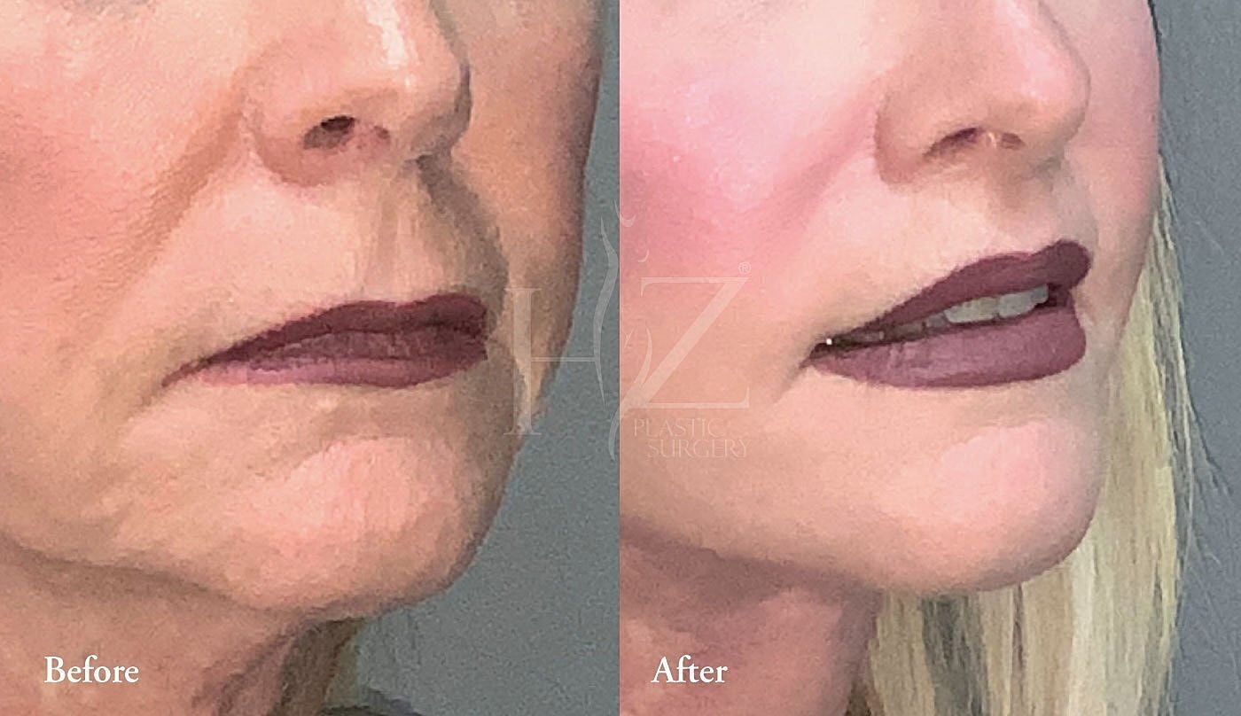 Before and after cosmetic procedure comparison.