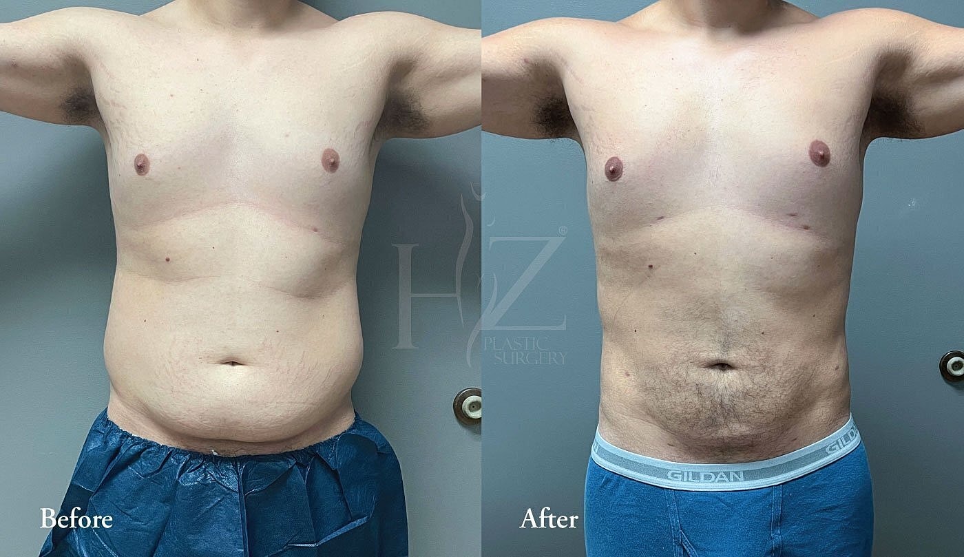 Body transformation before and after procedure.