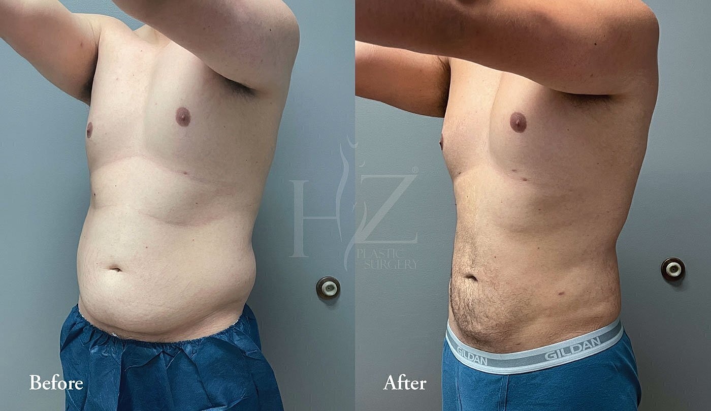 Before and after male body transformation surgery.