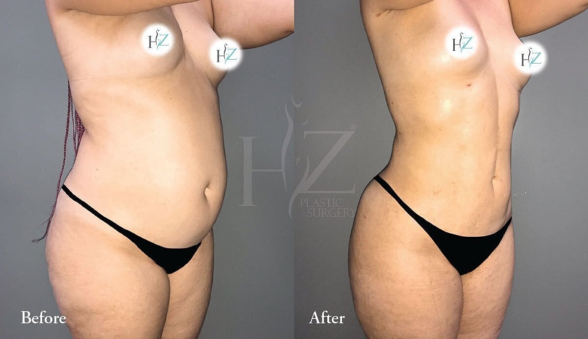 Before and after plastic surgery transformation.