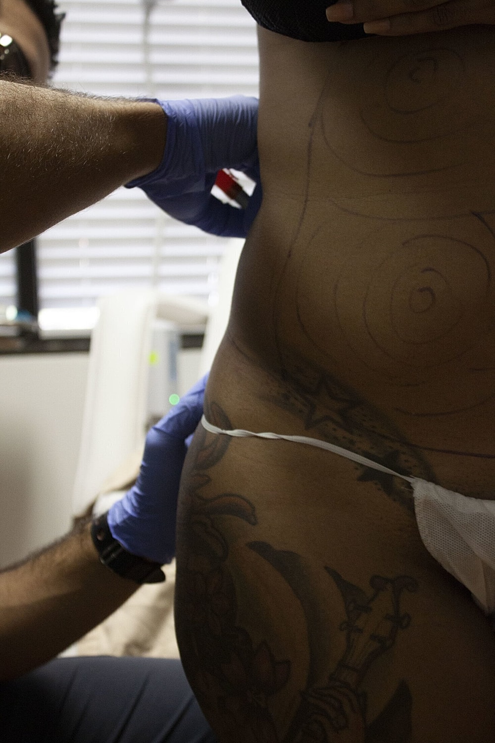 Medical professional marking skin for a procedure.