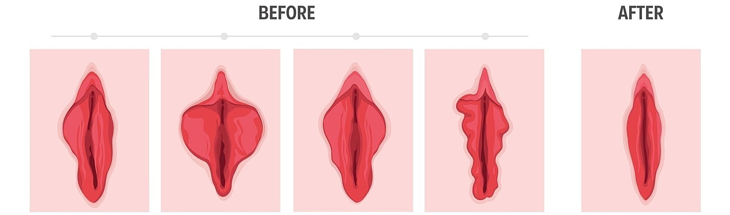 Illustration of anatomical changes before and after.
